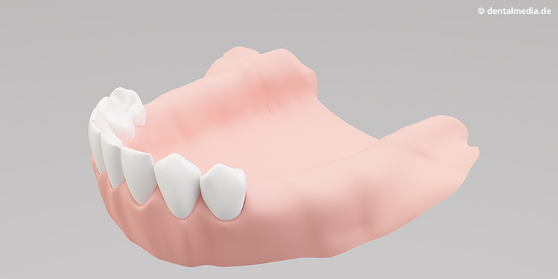 Geschiebetechnik : Kiefer mit bestehenden natürlichen Zähnen